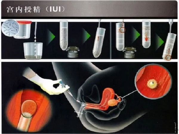 女性做人工授精的全过程,大概需要花多长时间插图2