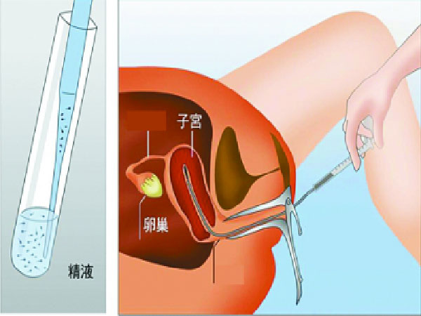 供精人工授精的过程图