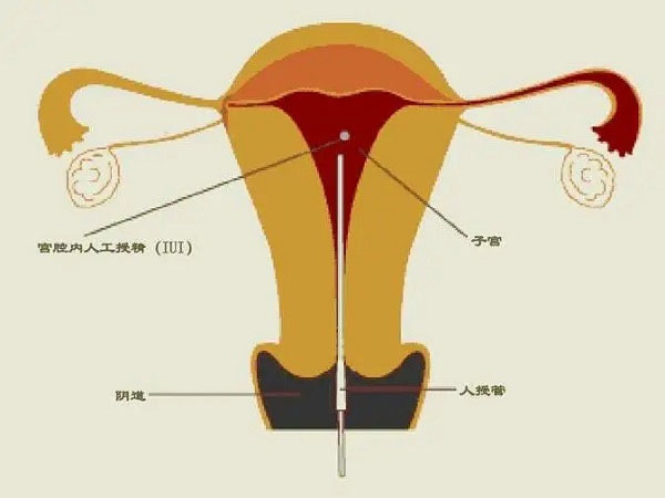 女性做人工授精的全过程,大概需要花多长时间插图