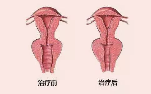 在重庆做阴道紧缩术会不会有副作用？