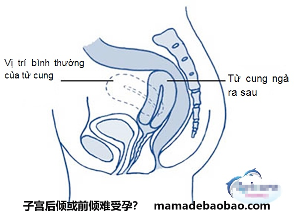 子宫后倾或前倾难受孕？