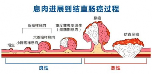 广州东大肛肠医院好不好肠癌高风险人群，40岁起需接受肠癌早筛插图